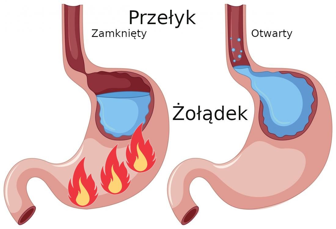 Refluks żołądka